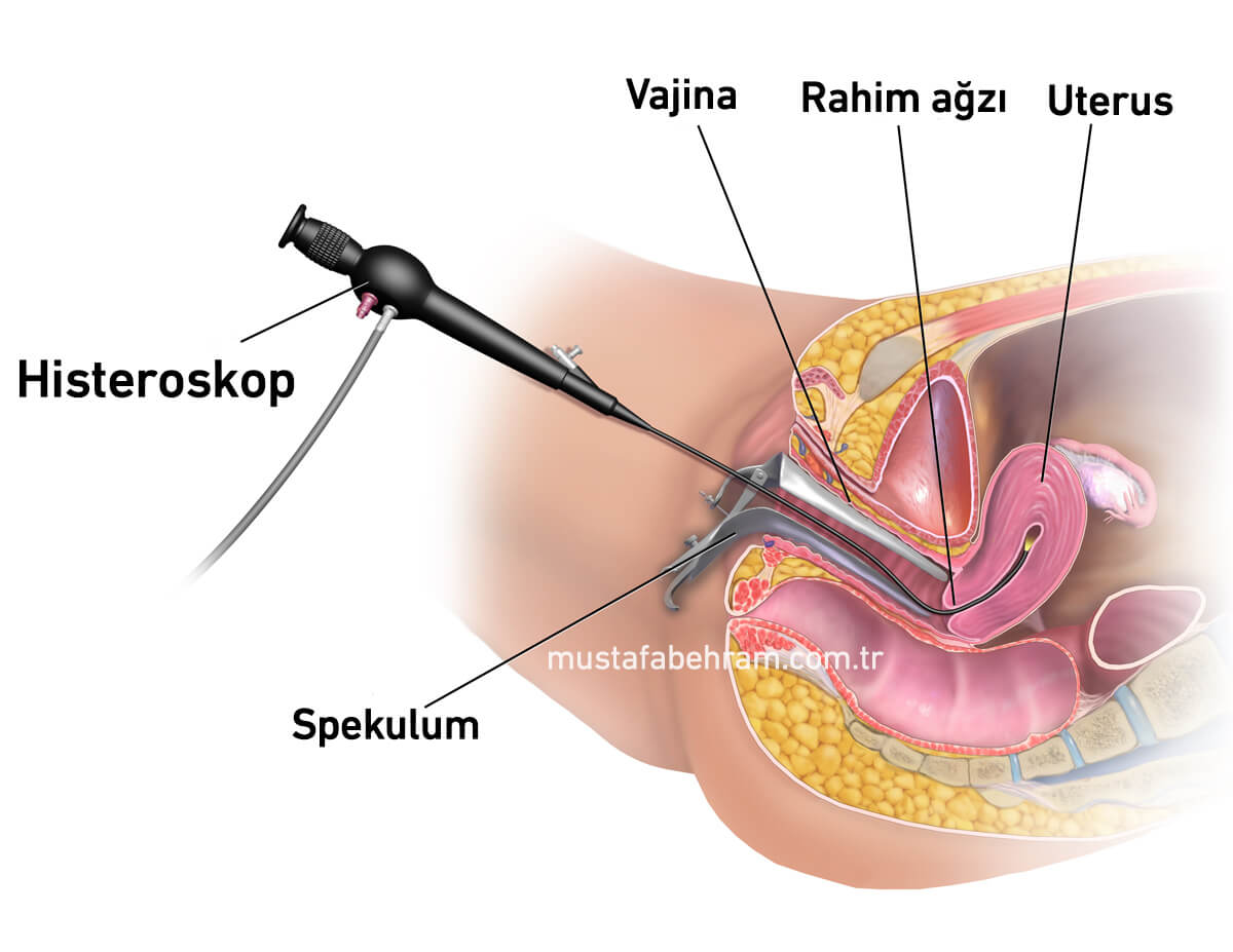 Histeroskopi istanbul
