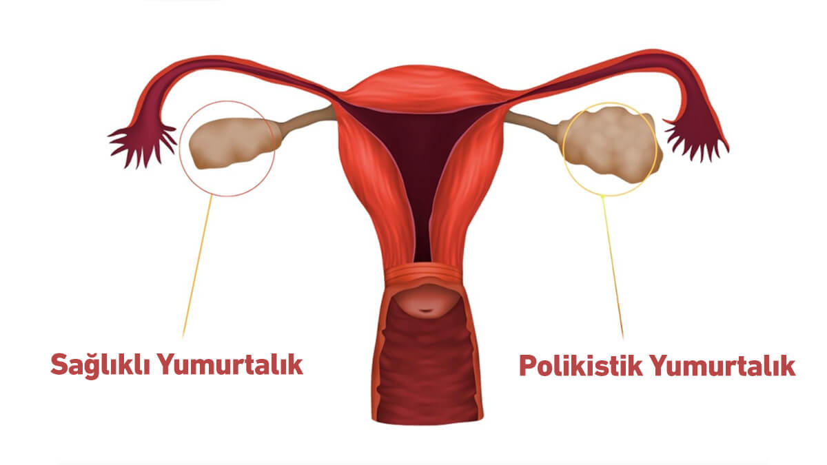 Polikistik Over sendromu